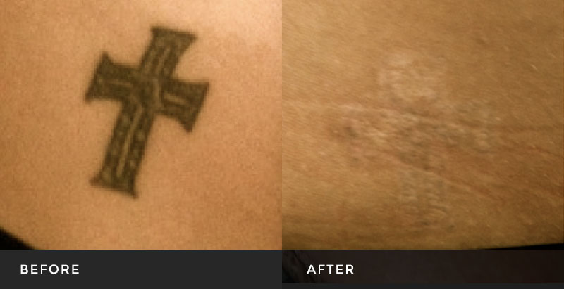 Discover more than 70 cutera enlighten tattoo removal best - in.eteachers