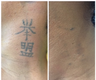 Tattoo removal TunisiaTo remove tattoo at a low price free quote