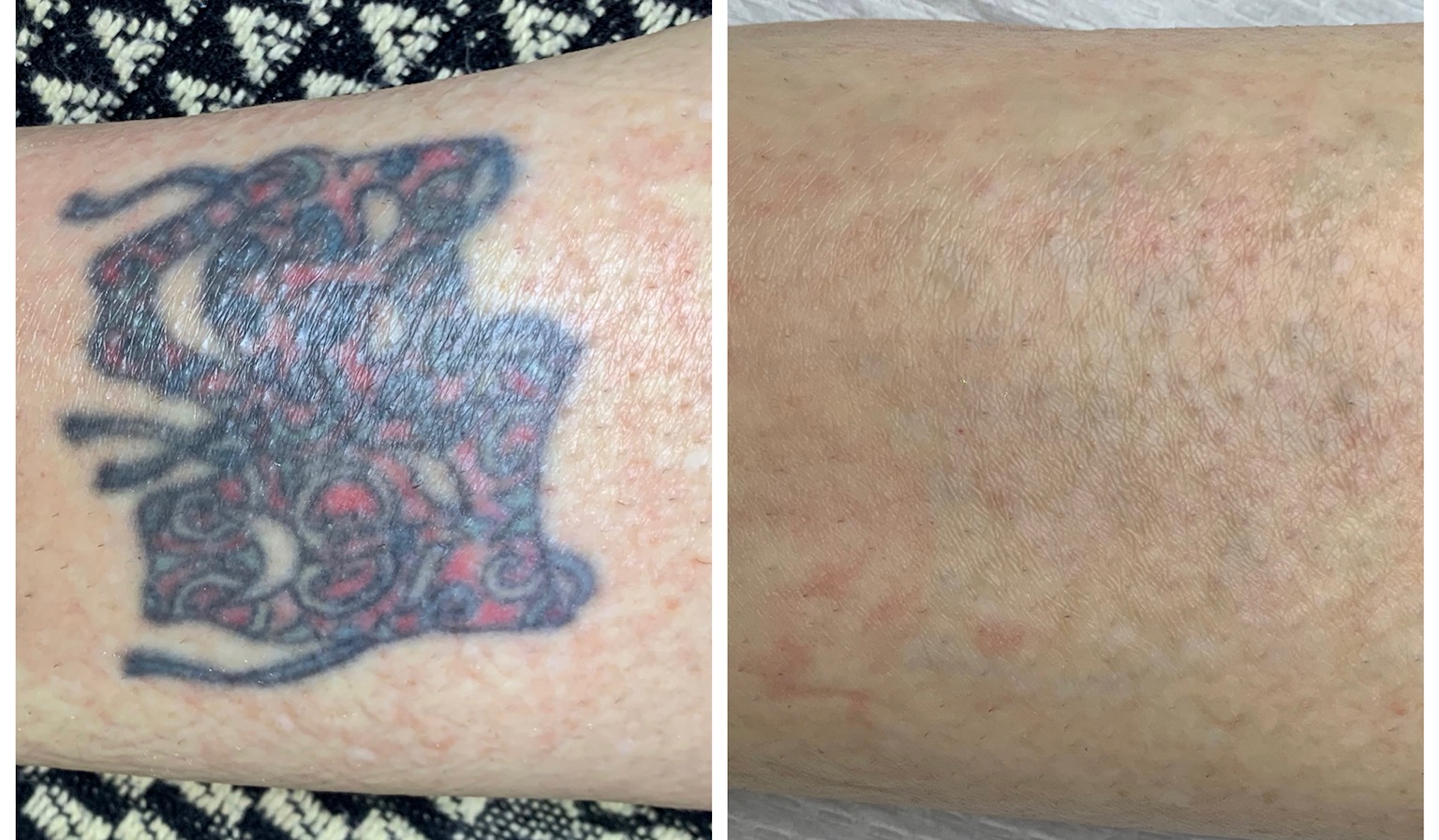 Tattoo Removal Montreal Treatment | Ideal Body Clinic